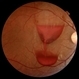 Setting Sail: A Striking View of a Boat-Shaped Subhyaloid Hemorrhage Setting Sail: A Striking View of a Boat-Shaped Subhyaloid Hemorrhage