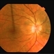 Choroidal Folds Choroidal Folds