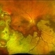 Peripheral CNVM with Extensive Scarring
