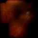Vasculitis Following Successful Treatment of Endophthalmitis