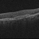 Aquired Vitelliform Maculopathy Aquired Vitelliform Maculopathy