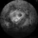 360 retinotomy for combined closed funnel tractional and rhematogenous retinal detachment 360 retinotomy for combined closed funnel tractional and rhematogenous retinal detachment