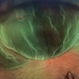 Retinal Detachment with Tear