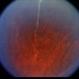 Multiple Sclerosis