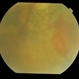 Traumatic Optic Neuropathy With Macular Scar