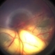Advanced Coats' Disease with Neovascular Glaucoma Advanced Coats' Disease with Neovascular Glaucoma