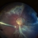 Dislocation of the Crystalline Lens with a Retinal Detachment Dislocation of the Crystalline Lens with a Retinal Detachment