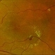 Retinal Macroaneurysm OS (RAM) Retinal Macroaneurysm OS (RAM)