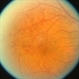 Superior Macular Branch Vein Occlusion Superior Macular Branch Vein Occlusion