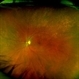 Rubella retinopathy Rubella retinopathy