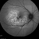 Serpiginous Choroidal Atrophy Serpiginous Choroidal Atrophy