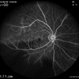Branch Retinal Artery Occlusion Branch Retinal Artery Occlusion