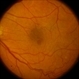 Macular Pseudo Hole