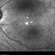 Diabetic Macular Edema
