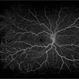 Central Retinal Vein Occlusion With Macular Edema
