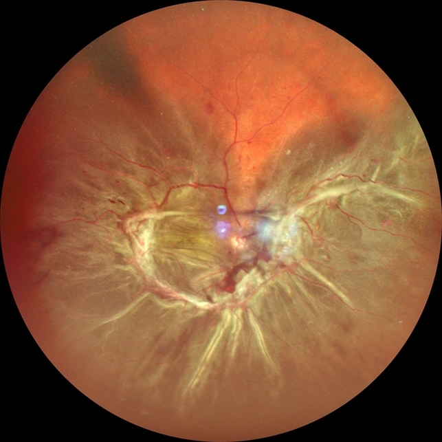 Diabetic Tractional Retinal Detachment Involving The Macula Od Icd 10