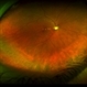 Pigmentary Retinal Dystrophy Pigmentary Retinal Dystrophy
