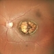 MACULAR COLOBOMA MACULAR COLOBOMA
