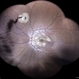 Intra-ocular Foreign Body with Vitreous Hemorrhage