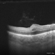Macular fold posterior microphthalmos OD Macular fold posterior microphthalmos OD