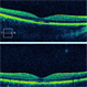 Laser Pointer injury to fovea.  Disrupted IS/OS Line Subfoveally. Laser Pointer injury to fovea.  Disrupted IS/OS Line Subfoveally.