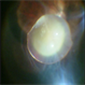 Vitreous Wrap  Around  The Dislocated Nucleus Vitreous Wrap  Around  The Dislocated Nucleus