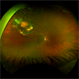 Retinal Capillary Hemangioma