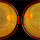 Central Retinal Artery Occlusion Central Retinal Artery Occlusion
