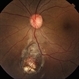 Retinal Colomoba Retinal Colomoba