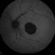 Central Areolar Choroidal Dystrophy Central Areolar Choroidal Dystrophy