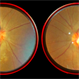 Optic Nerve Head Melanocytoma