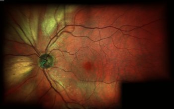 myelinated retinal nerve fiber layer myelinated retinal nerve fiber layer