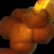 Leber's Miliary Aneurysm With Epiretinal Membrane Leber's Miliary Aneurysm With Epiretinal Membrane