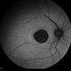 Central areolar choroidal dystrophy Central areolar choroidal dystrophy