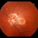 Subretinal Fibrosis (PPCNVM and POHS) OS