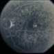 Macular Hole Evolving / Lamellar Hole Macular Hole Evolving / Lamellar Hole