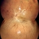 Von Hippel-Lindau Syndrome Von Hippel-Lindau Syndrome