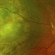 Nasal Choroidal Mass Nasal Choroidal Mass
