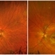 Central Areolar Choroidal Dystrophy Central Areolar Choroidal Dystrophy
