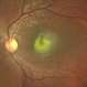 Central serous chorioretinopathy with subretinal fibrin Central serous chorioretinopathy with subretinal fibrin