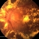 Diabetic Retinopathy, CSME, Color Fundus Photo