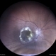 Circinate Retinopathy in a Case of Old Vein Occlusion Circinate Retinopathy in a Case of Old Vein Occlusion