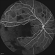 Acute Idiopathic Occlusive Retinal Vasculitis