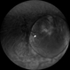 Widefield Retro Mode Image of Fundus Coloboma Widefield Retro Mode Image of Fundus Coloboma