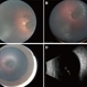 Oval Pigmented Vitreous Cyst Oval Pigmented Vitreous Cyst