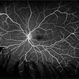 Von Hippel-Lindau Syndrome with Retinal Hemangiomas Von Hippel-Lindau Syndrome with Retinal Hemangiomas