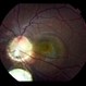 Colobomatous Optic Disc Maculopathy Colobomatous Optic Disc Maculopathy