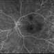 Retinal Vasculitis Retinal Vasculitis