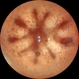 Retinitis Pigmentosa with Macular Hole with Posterior Subcapsular Cataract Retinitis Pigmentosa with Macular Hole with Posterior Subcapsular Cataract