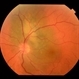 Peripapillary Choroidal Mass